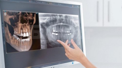 Компьютерная дентальная 3D-томография