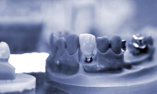 показания и противопоказания есть для проведения имплантации зубов